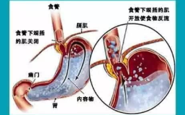 站桩对胃反流性食管炎有效果吗为什么,站桩改善胃反流性食管炎的原理与效果概述